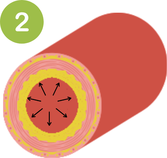 arteriosclerosis2